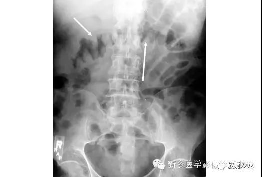 详细腹部平片解剖+正常表现+读片技巧+病例分析