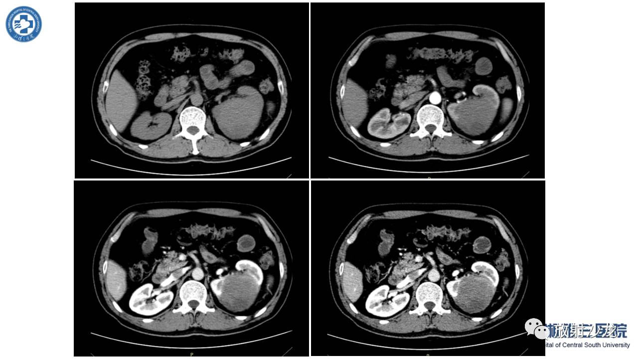 「每日一例｜489例」男，左侧腰部撞伤后疼痛3月