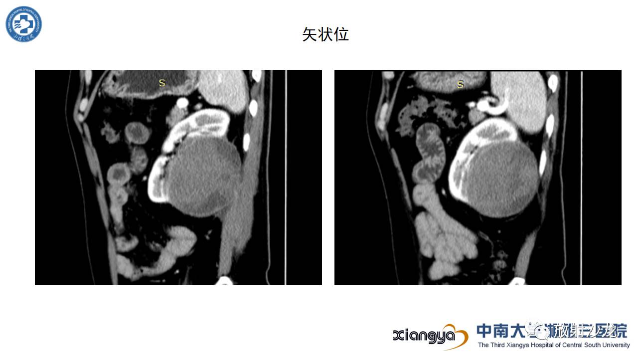 「每日一例｜489例」男，左侧腰部撞伤后疼痛3月