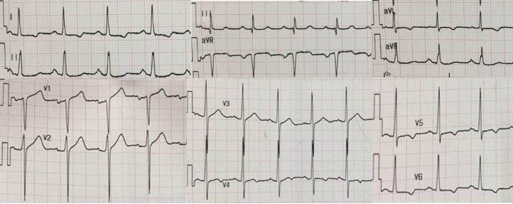 高血压病历的鉴别诊断,高血压合并症怎么检查