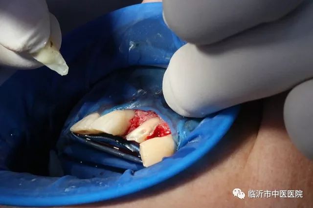 北京口腔医院可以接断牙吗,牙科断牙怎么补救