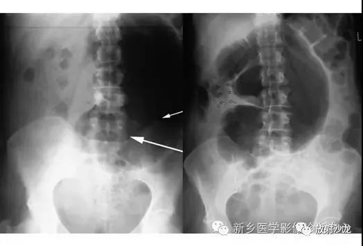 详细腹部平片解剖+正常表现+读片技巧+病例分析