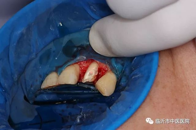 北京口腔医院可以接断牙吗,牙科断牙怎么补救