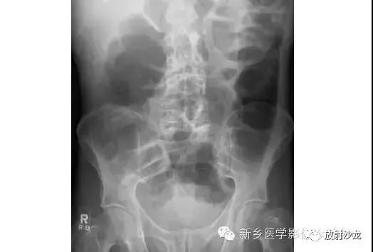 详细腹部平片解剖+正常表现+读片技巧+病例分析