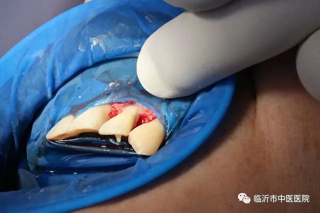 北京口腔医院可以接断牙吗,牙科断牙怎么补救