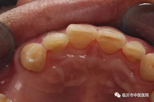 北京口腔医院可以接断牙吗,牙科断牙怎么补救