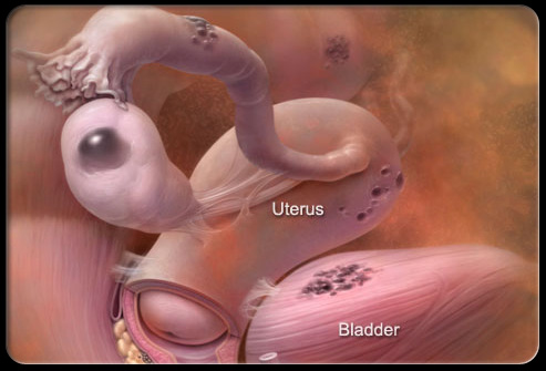 盆腔疼痛怎么引起的,盆腔疼痛是什么原因引起的