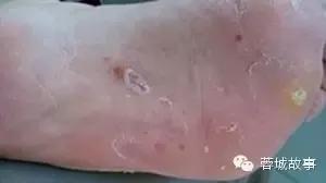 教你对付湿疹,别让湿疹误了宝宝颜值