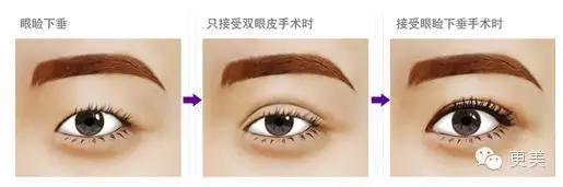 抬头纹手术会不会影响眼睛,抬头纹手术后有后遗症吗