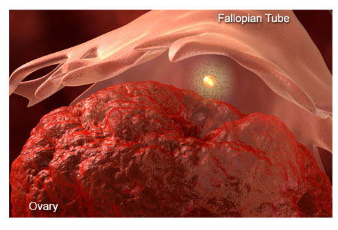 盆腔疼痛怎么引起的,盆腔疼痛是什么原因引起的