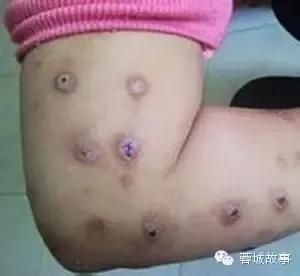 教你对付湿疹,别让湿疹误了宝宝颜值