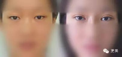 抬头纹手术会不会影响眼睛,抬头纹手术后有后遗症吗