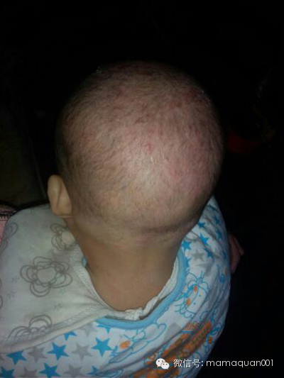 广州皮肤湿疹专家,湿疹皮肤干燥瘙痒挠出血