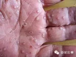 教你对付湿疹,别让湿疹误了宝宝颜值