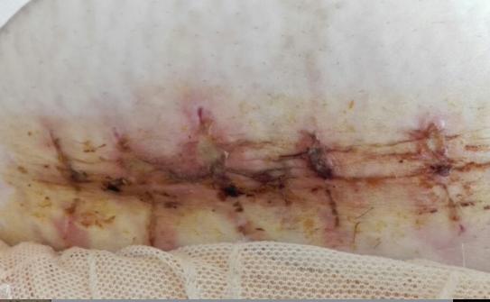 产后瘙痒症会自然好吗,产后下阴瘙痒可以用什么药