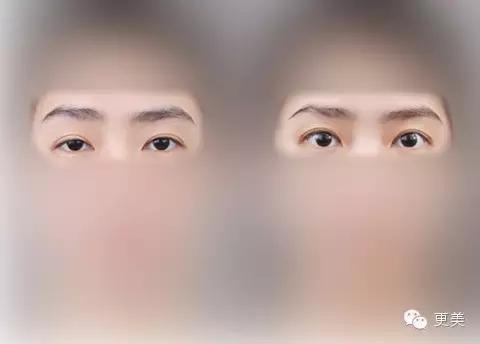 抬头纹手术会不会影响眼睛,抬头纹手术后有后遗症吗