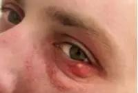 针眼用什么方法好得快,针眼切忌挤压排脓