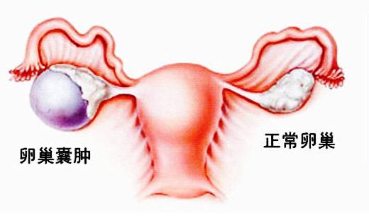 女人没有卵巢会怎样？是不是就不是女人了？