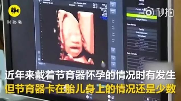 刚出生的婴儿顶着节育环,戴宫内节育器妊娠