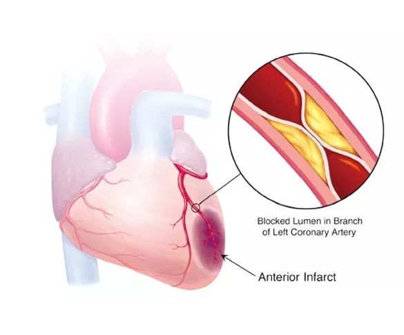 中医中药治疗冠心病,中医能有效治疗冠心病吗