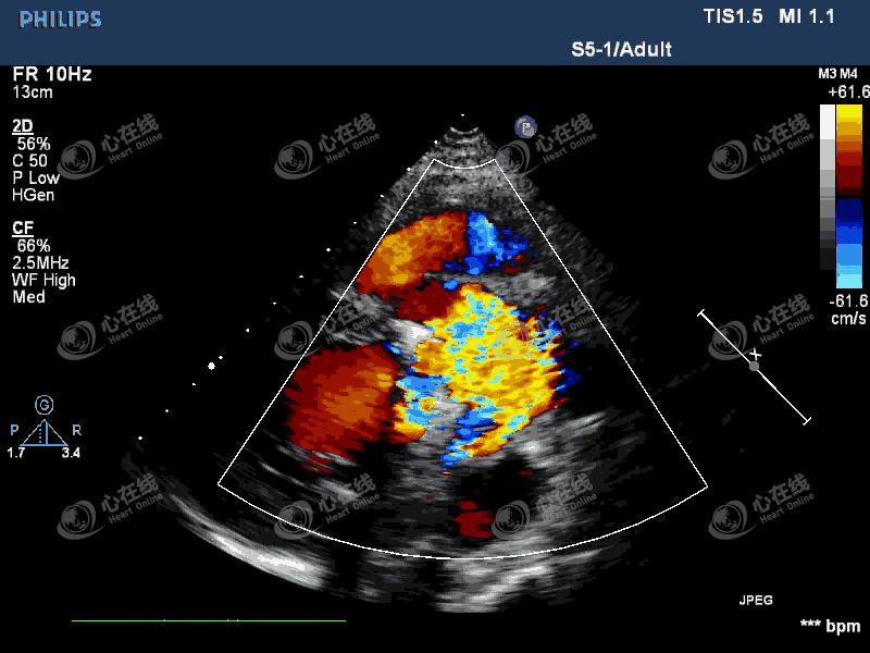 「“医”站到底」26：主动脉瓣机械瓣置换术后发热，您答对了吗？