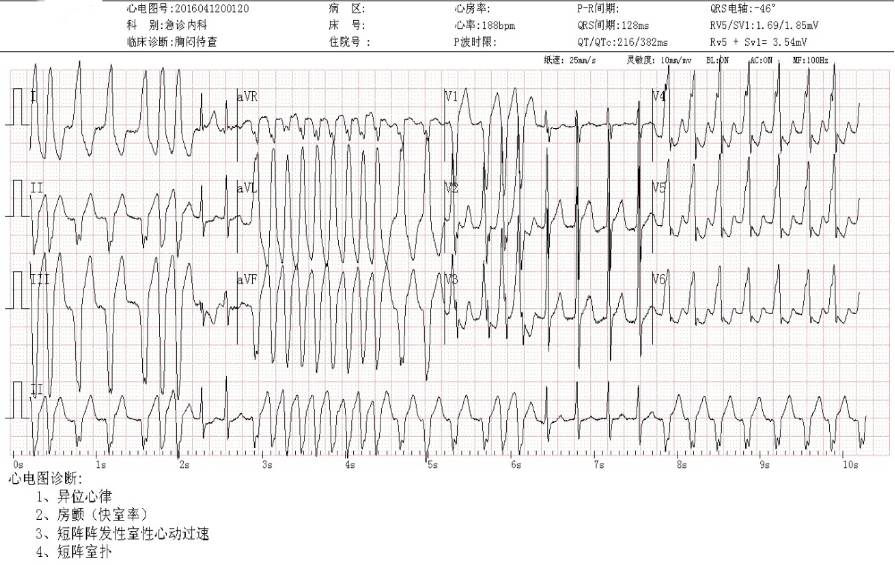 预激综合征伴房颤的首选治疗,预激综合征合并房颤首选治疗药物