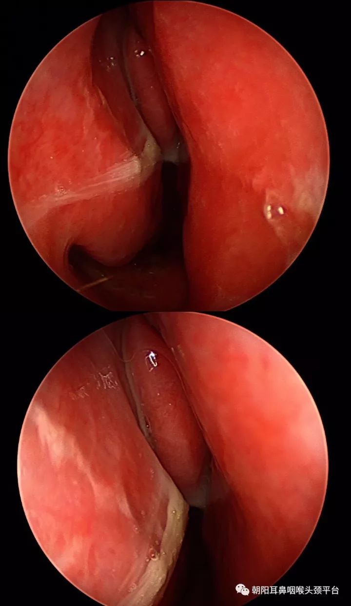 感冒了头疼什么原因,感冒了头疼怎么回事