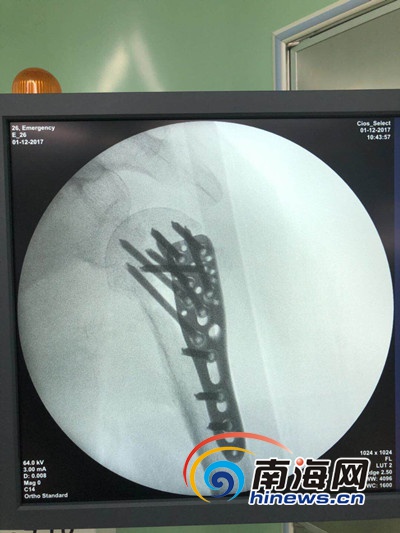 老人跌倒骨折微创手术康复,八旬老人腰椎骨折做微创手术