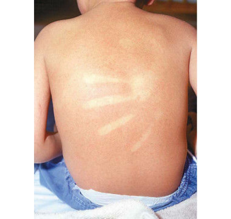 猩红热颜色,猩红热又开始了吗