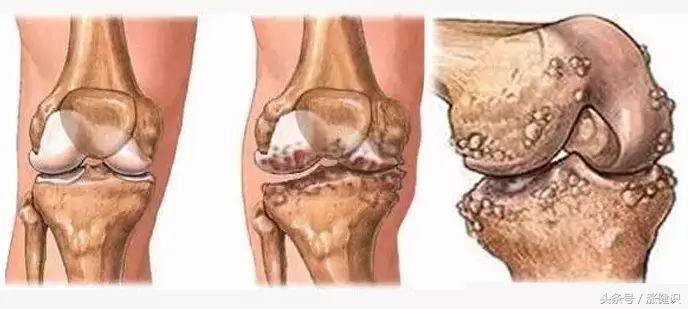 骨刺是越磨损长得越快吗,骨刺一般多久才会消