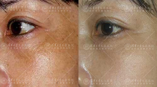 双玻嫩肤抗衰老效果,双波嫩肤