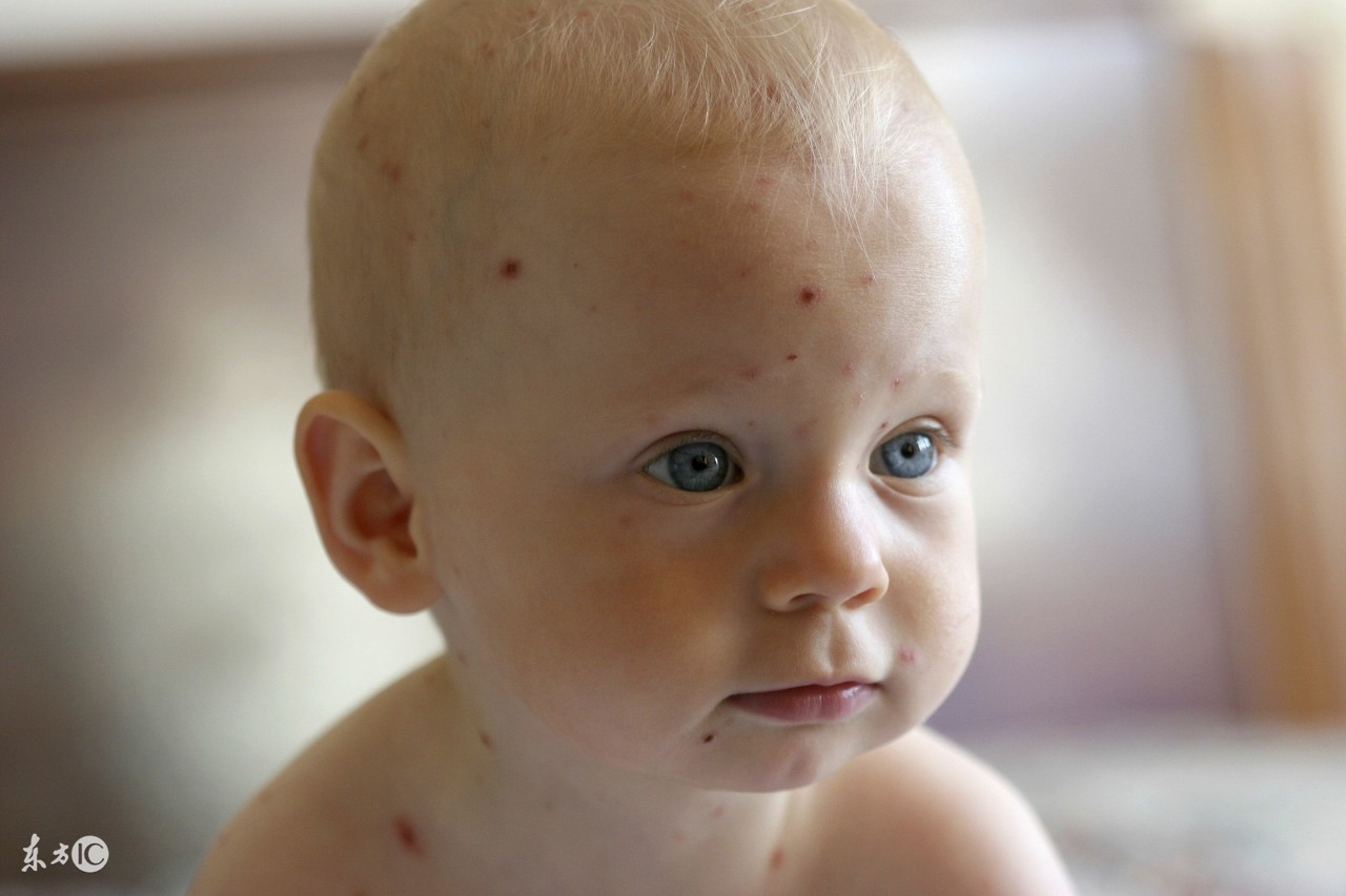 如何预防水痘高发,冬季传染病水痘的预防方法有哪些