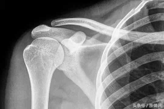 骨刺是越磨损长得越快吗,骨刺一般多久才会消