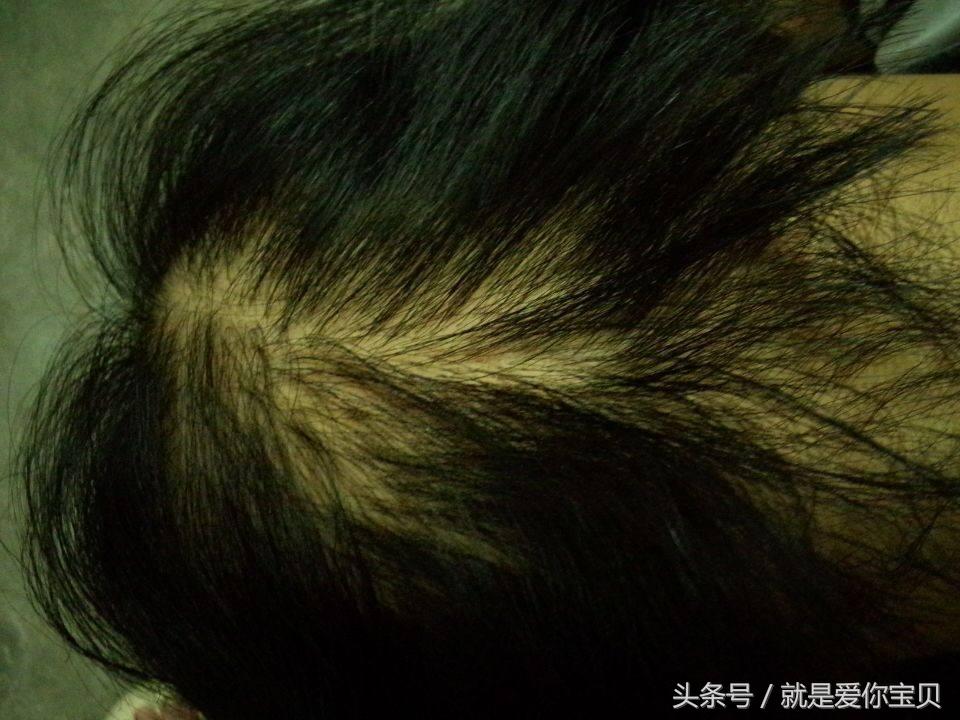 产后哺乳期“脱发”是什么原因造成的？“脱发”又该如何护发？