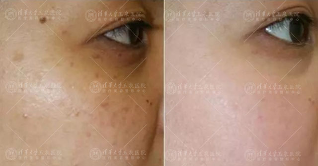 双玻嫩肤抗衰老效果,双波嫩肤