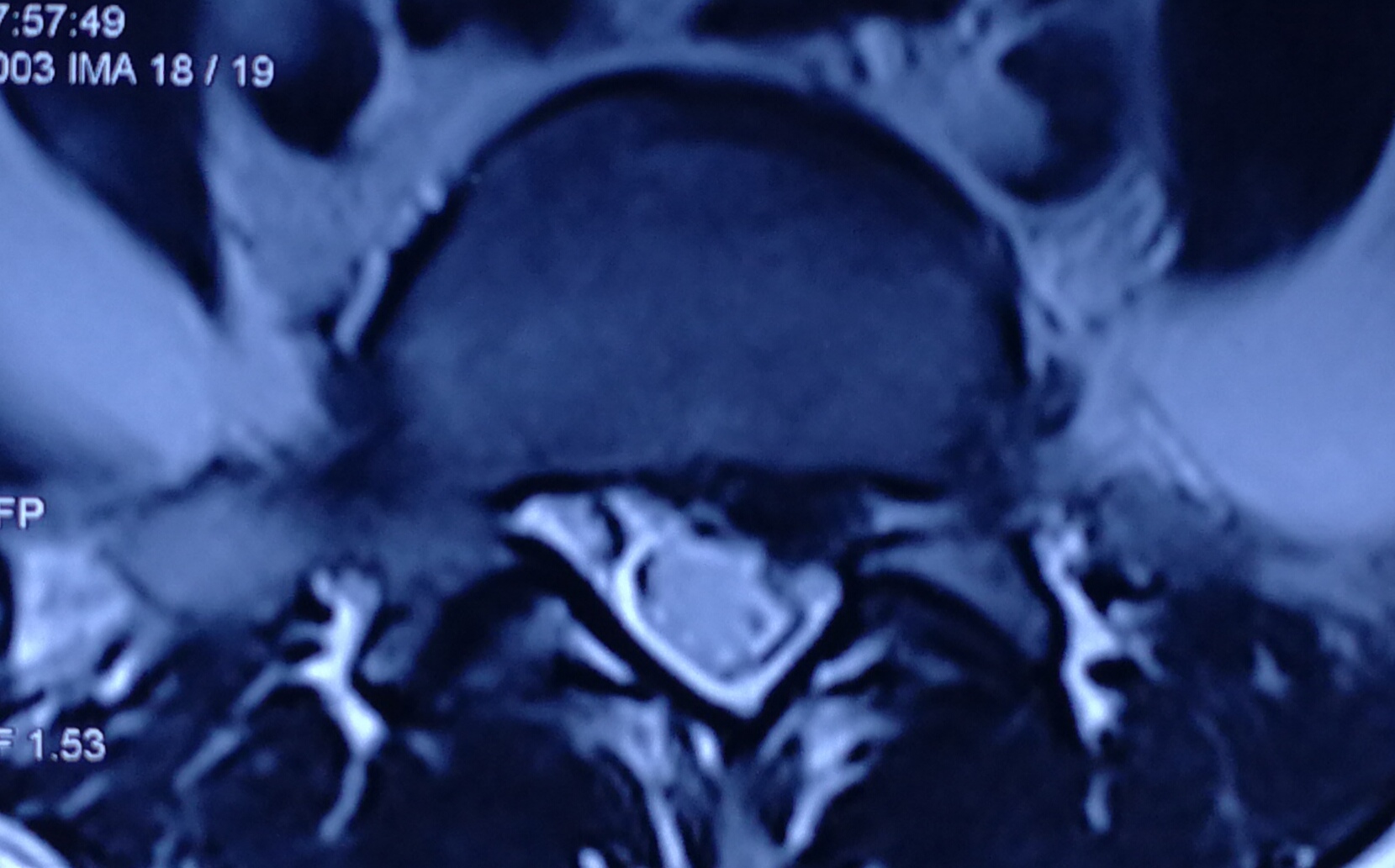 腰椎间盘突出怎么治疗好得快,女人腰椎间盘突出的亲身经历