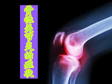 骨性关节炎出现的症状不能被人忽视