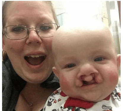 怀孕5个月了查出宝宝兔唇,孕妈没有按时产检娃有兔唇