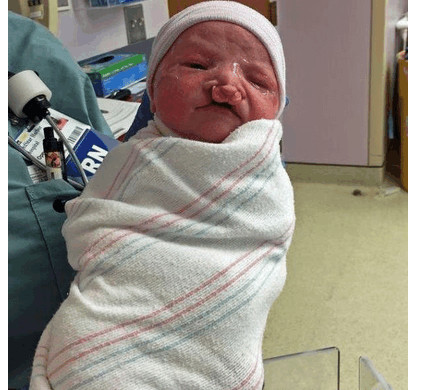 怀孕5个月了查出宝宝兔唇,孕妈没有按时产检娃有兔唇