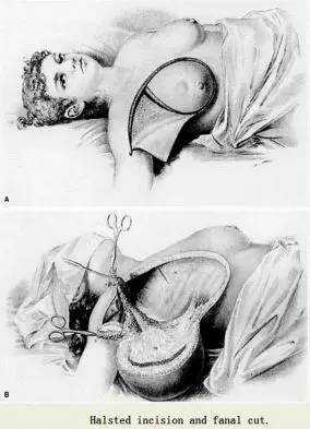 得了乳腺癌该选择哪种治疗,乳腺癌每种治疗方案都能用上吗