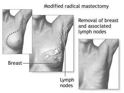 得了乳腺癌该选择哪种治疗,乳腺癌每种治疗方案都能用上吗