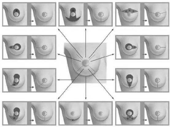 得了乳腺癌该选择哪种治疗,乳腺癌每种治疗方案都能用上吗