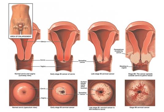 高发病率的宫颈炎患上该病真的不需要治疗吗？