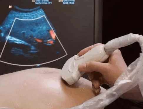 怀孕5个月胎儿畸形做了引产费用,怀孕三个月检查出胎儿畸形引产