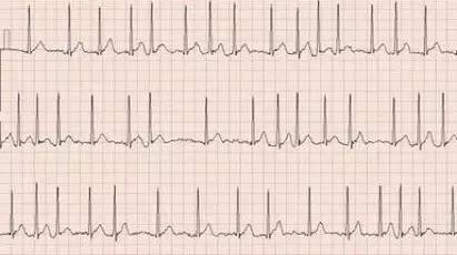 让房颤快而乱的心跳慢下来、跳整齐，用什么药？