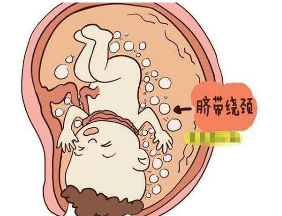 如果胎儿绕脐带了孕妈会有反应吗,孕中期脐带绕颈一周怎么快速矫正