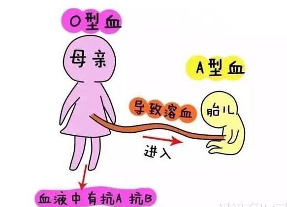 孕妇abo溶血有什么关注的,怀孕溶血是什么血型才会发生的