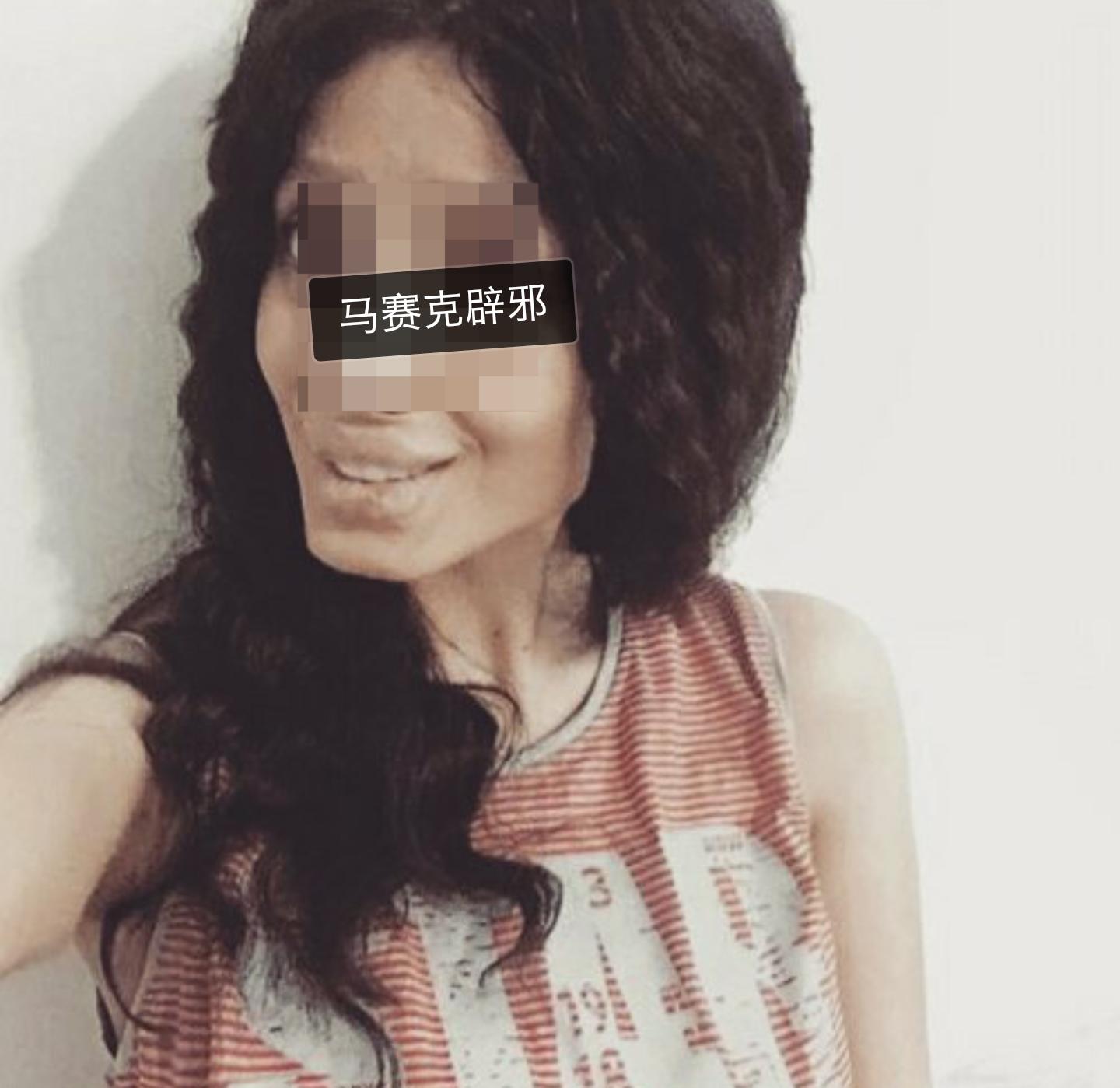 一次整形换来5次痛苦手术,朱莉做了什么手术