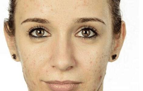 激素脸后色素沉淀怎么办,激素脸导致的色素沉着怎么办