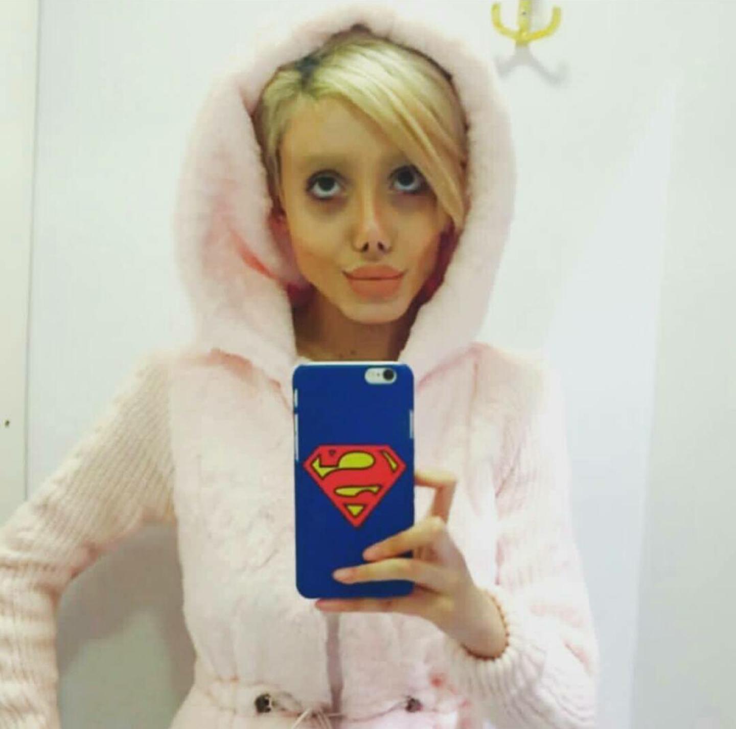 一次整形换来5次痛苦手术,朱莉做了什么手术